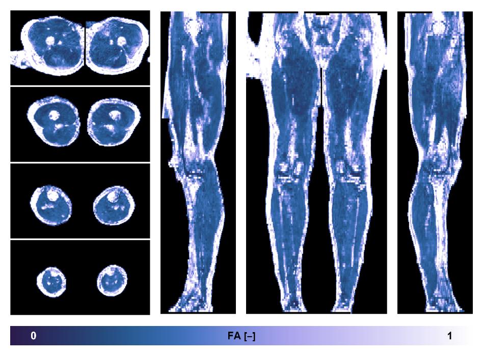 IVIM corrected whole leg muscle fractional anisotropy obtained from diffusion tensor imaging.